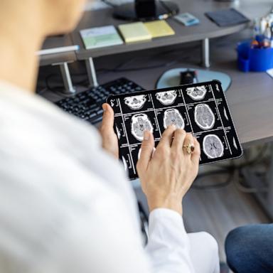 PHOTO: A doctor looks at a brain x-ray.