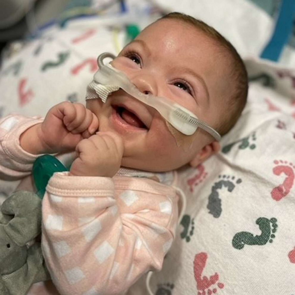 VIDEO: Twin baby with one lung survives against all odds