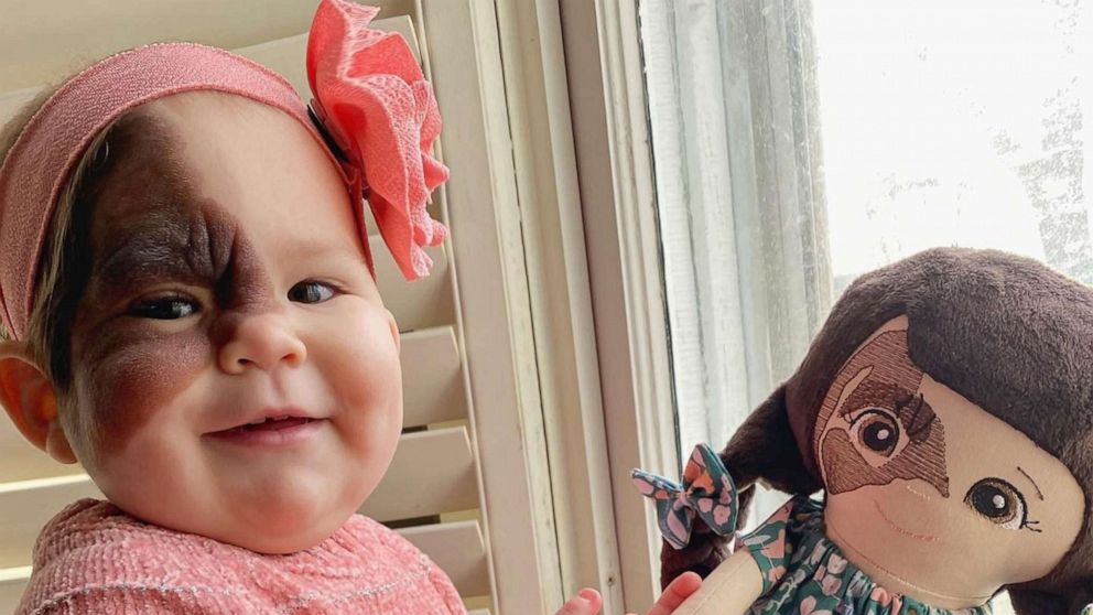 Mom on mission to show daughter with rare birthmark that she is beautiful -  Good Morning America