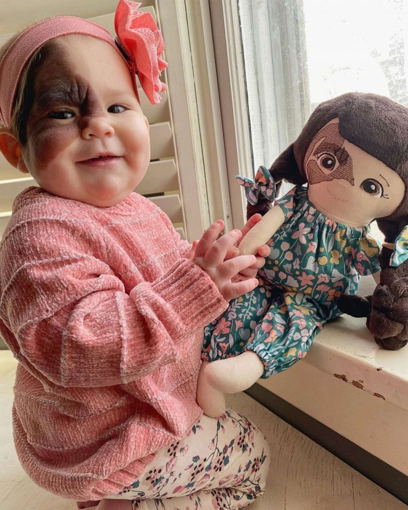 PHOTO: Winry Hall poses with a doll that has a birthmark like hers in an undated family photo.