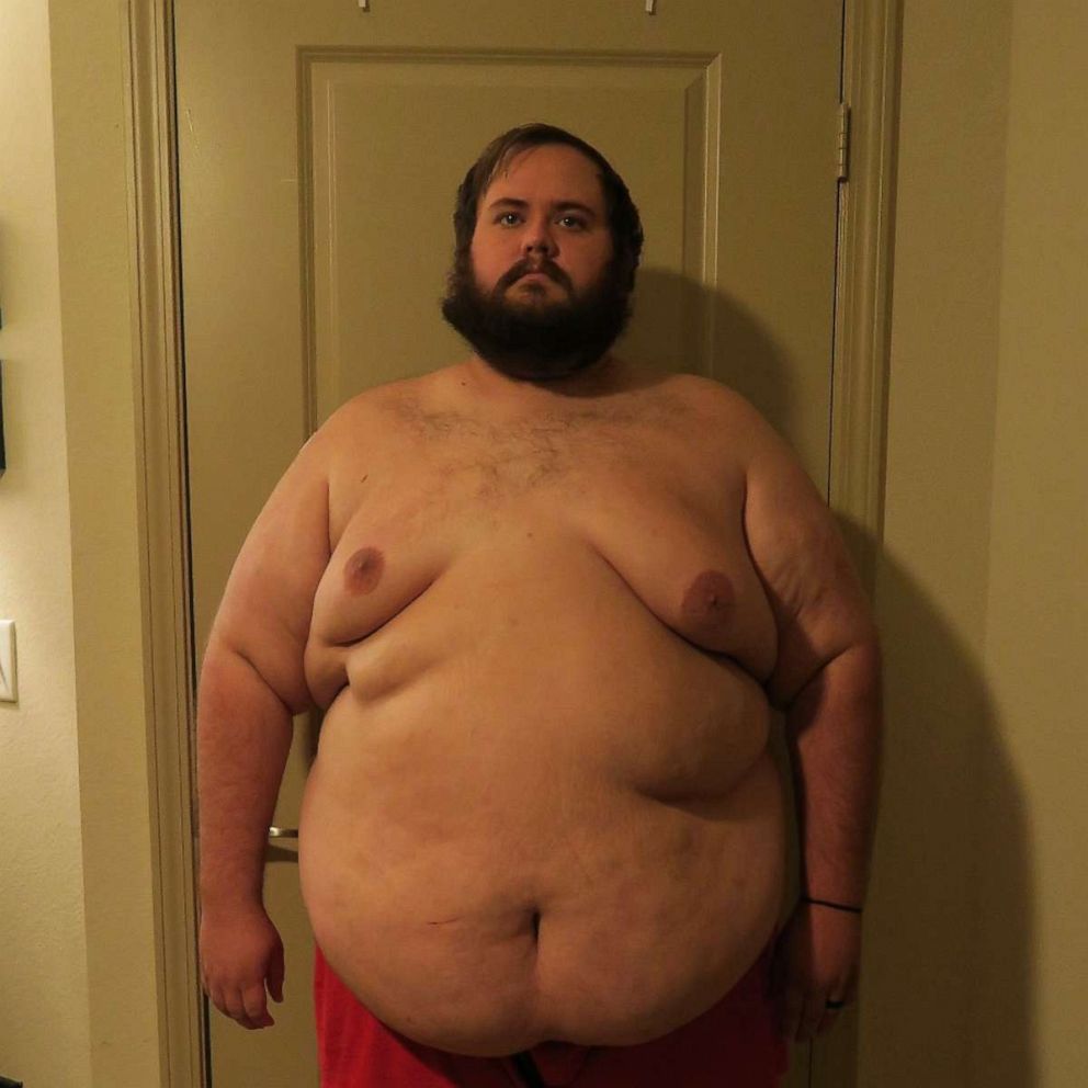 PHOTO: Christopher Hasty weighed in at 462 pounds before he underwent his duodenal switch surgery.