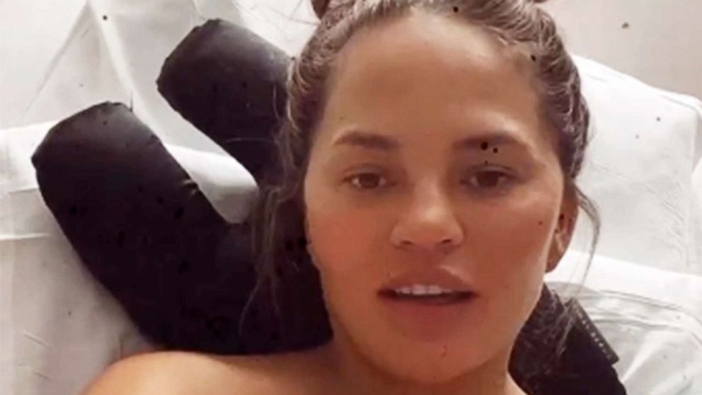 PHOTO: Chrissy Teigen reveals her pregnancy related hospitalization in her Instagram Story posted on Sept. 28, 2020.