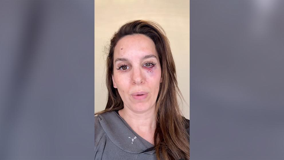 PHOTO: Christy Carlson Romano appears in a video she posted to her Instagram account, describing an accident that occurred while shooting clay pigeons.