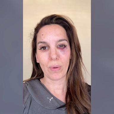 PHOTO: Christy Carlson Romano appears in a video she posted to her Instagram account, describing an accident that occurred while shooting clay pigeons.