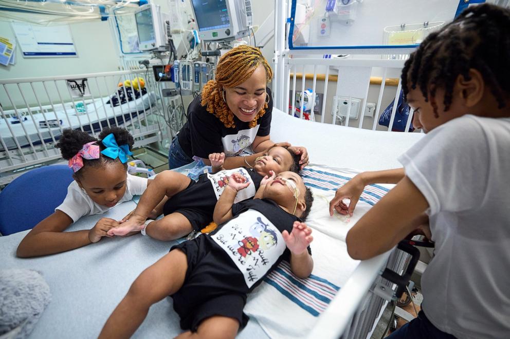 PHOTO: Twins Amari and Javar Ruffin were separated at Children’s Hospital of Philadelphia after sharing part of their sternum, diaphragm, abdominal wall and liver.