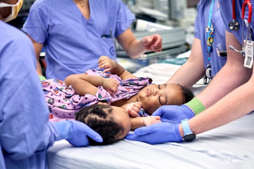 PHOTO: Twins Amari and Javar Ruffin were separated at Children’s Hospital of Philadelphia after sharing part of their sternum, diaphragm, abdominal wall and liver.