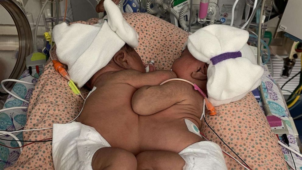 VIDEO: 2nd formerly conjoined twin heads home