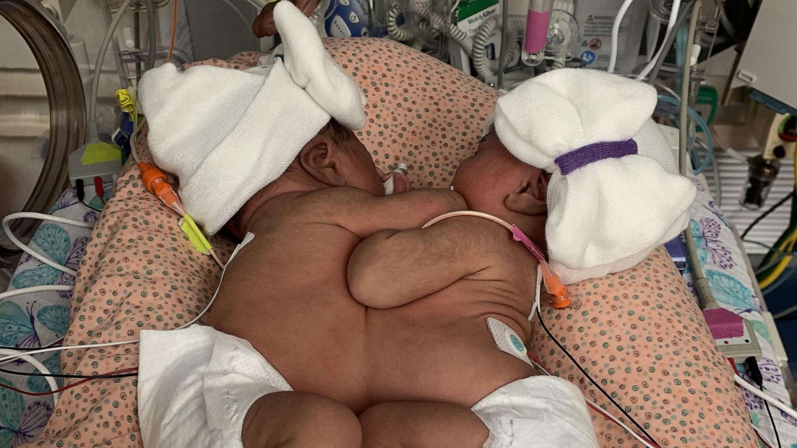 PHOTO: JamieLynn and AmieLynn Finley conjoined twins pictured before their separation.