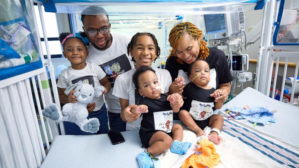 PHOTO: Twins Amari and Javar Ruffin were separated at Children’s Hospital of Philadelphia after sharing part of their sternum, diaphragm, abdominal wall and liver.