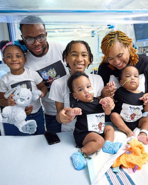 Twin brothers born conjoined celebrate 1st birthday after