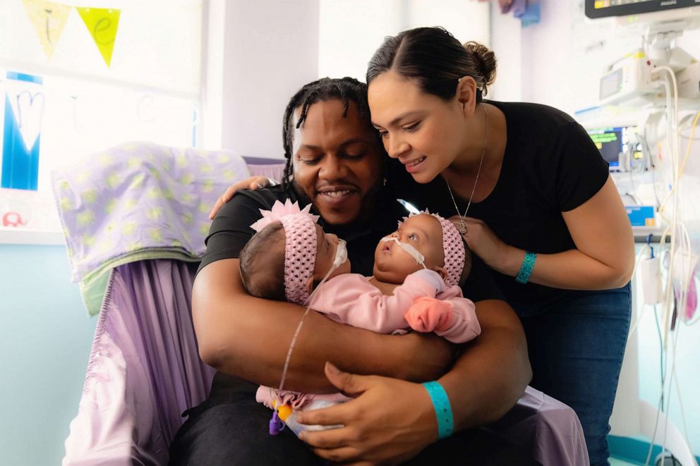 PHOTO: Amanda Arciniega and James Finley hold their twin daughters, who were born conjoined.