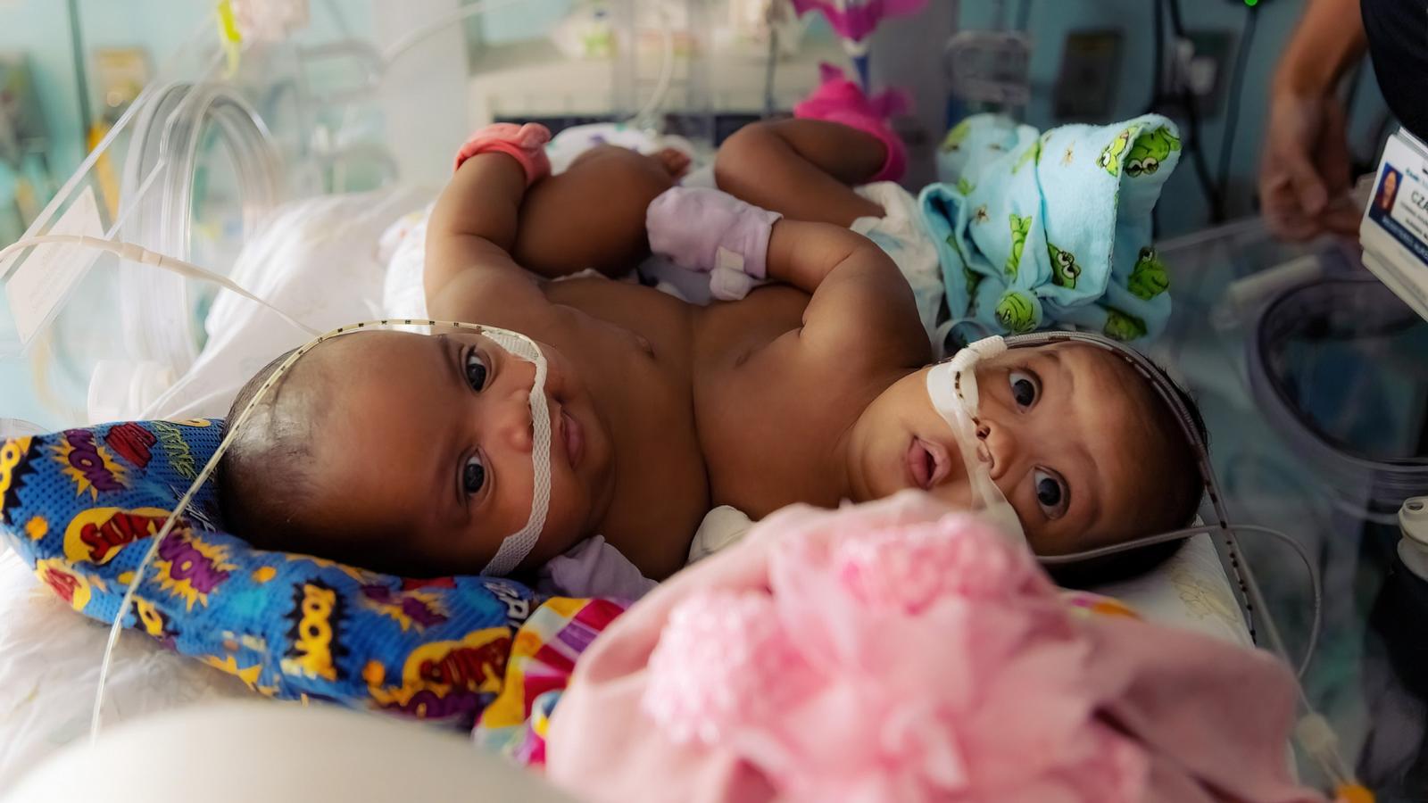 PHOTO: AmieLynn and JamieLynn Finley were born in October 2022. The formerly conjoined twin sisters are now 1 year old.