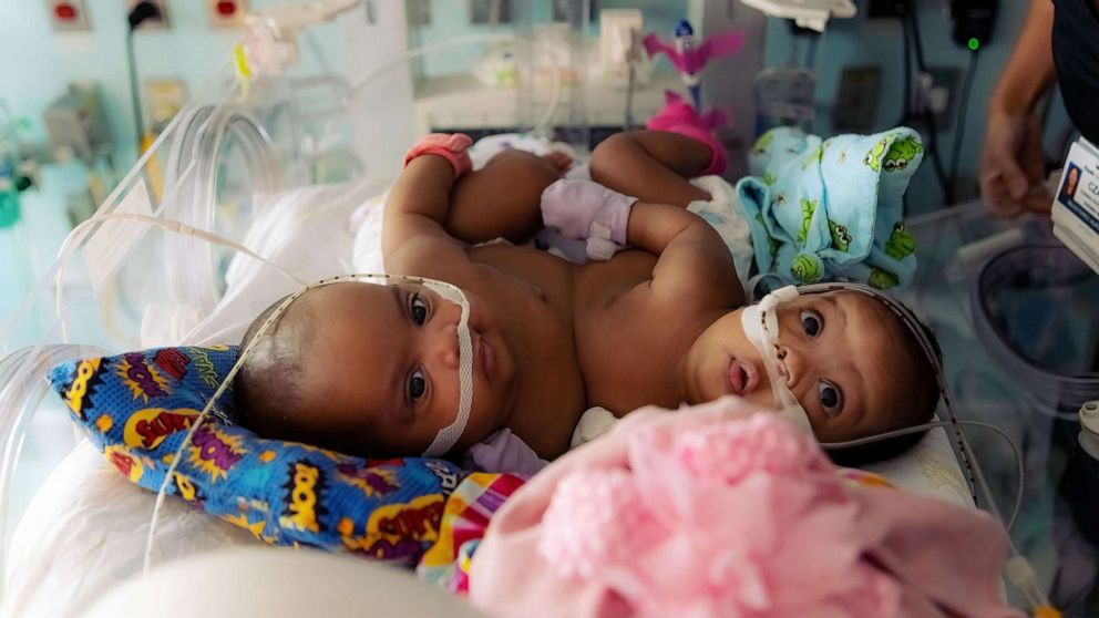 PHOTO: Amanda Arciniega and James Finley's conjoined twin daughters, JamieLynn and AimeeLynn, underwent separation surgery at Cook Children's Medical Center in Fort Worth, Texas.