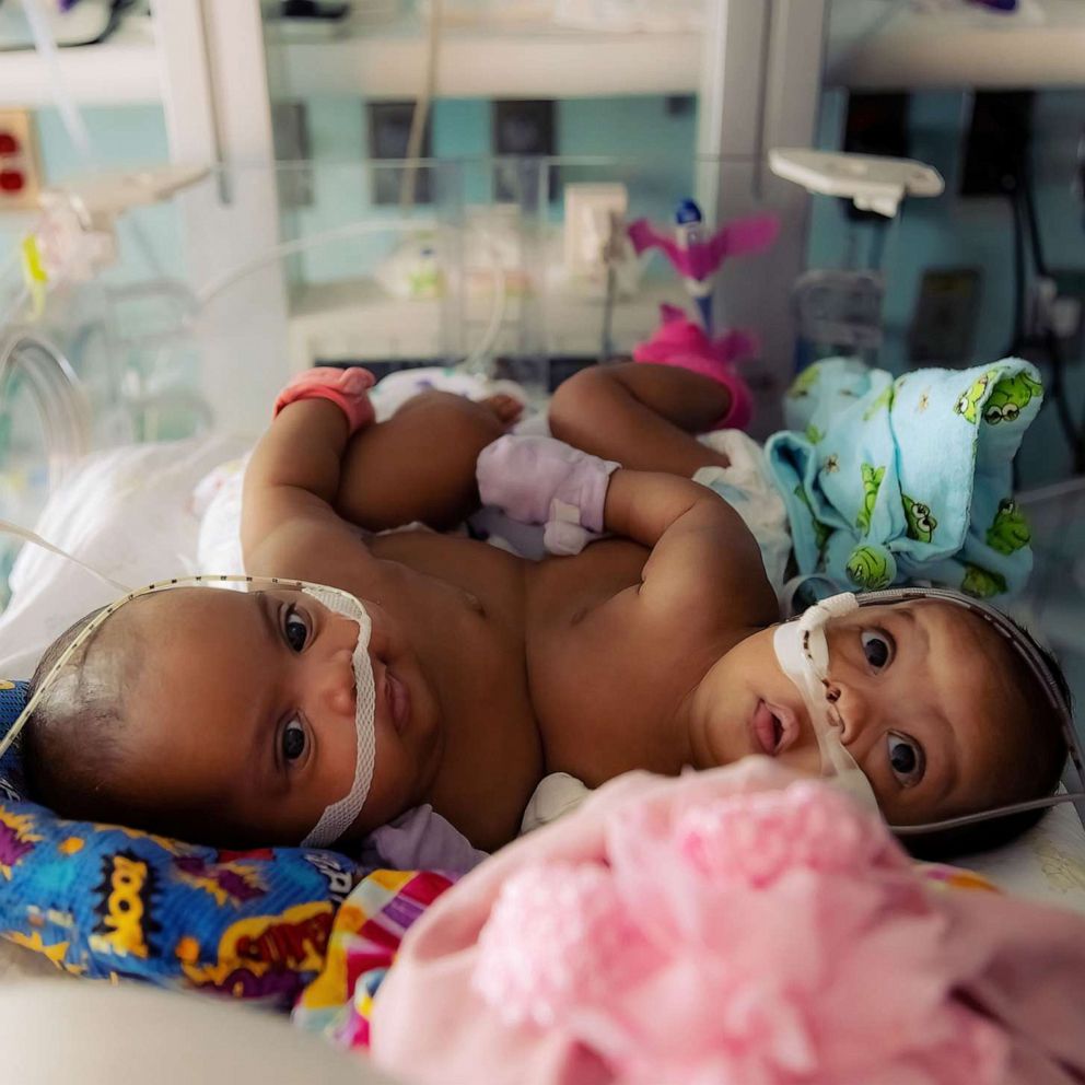 Conjoined Twin Sisters Undergo Successful Surgery To Separate Abc News