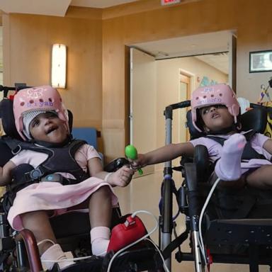 PHOTO: Hiyab and Wuhbto, two-year-old twins who were born conjoined, have undergone successful separation surgery.