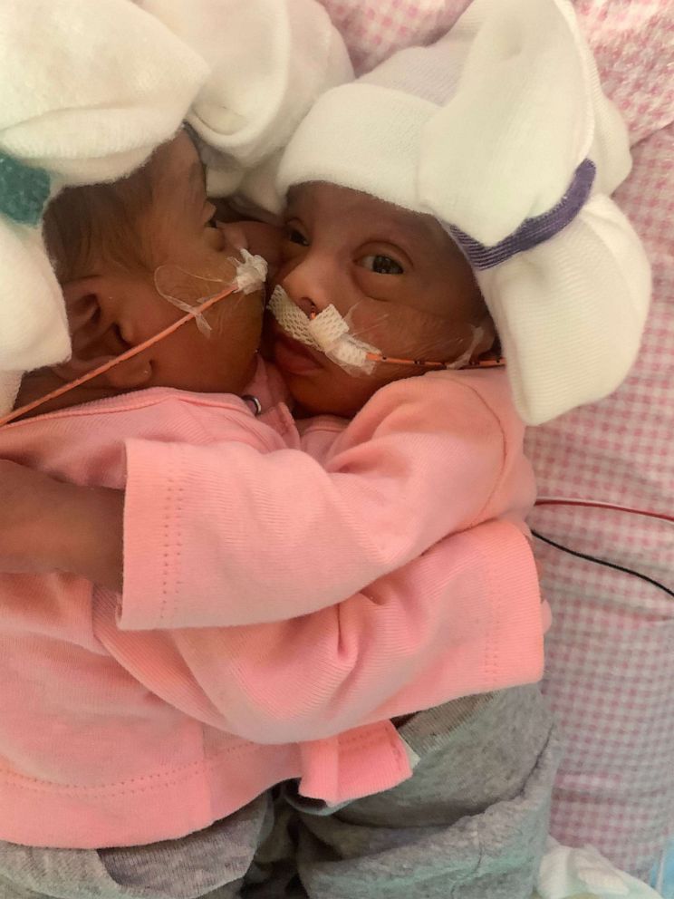 PHOTO: Amanda Arciniega and James Finley's conjoined twin daughters, JamieLynn and AimeeLynn, underwent separation surgery at Cook Children's Medical Center in Fort Worth, Texas.