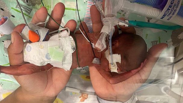 Boy Born At 21 Weeks Named World s Most Premature Infant To Survive boy-born-at-21-weeks-named-world-s-most-premature-infant-to-survive