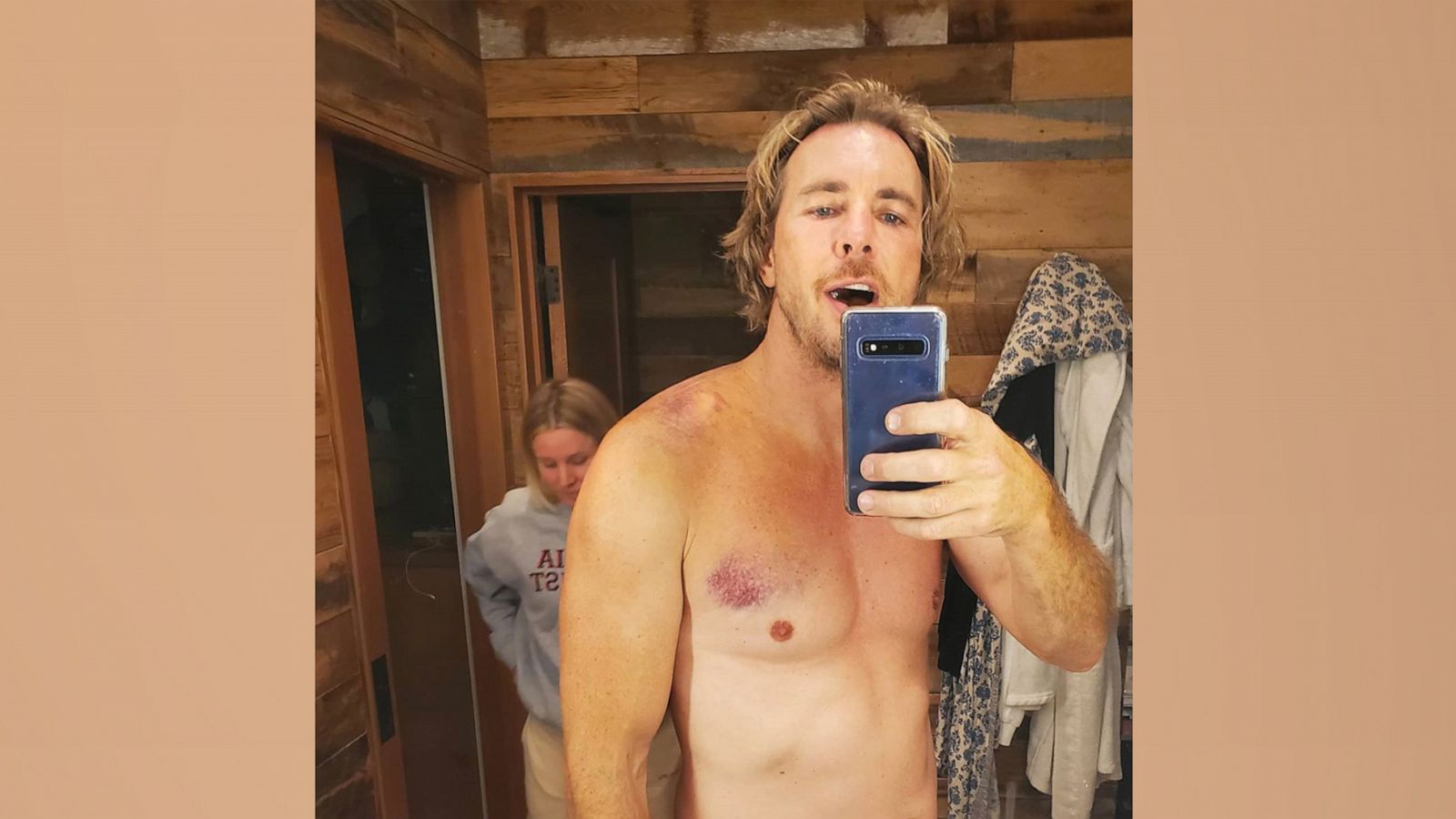 PHOTO: In this photo posted to his Instagram account, Dax Shepherd shows his injuries after a motorcycle accident.