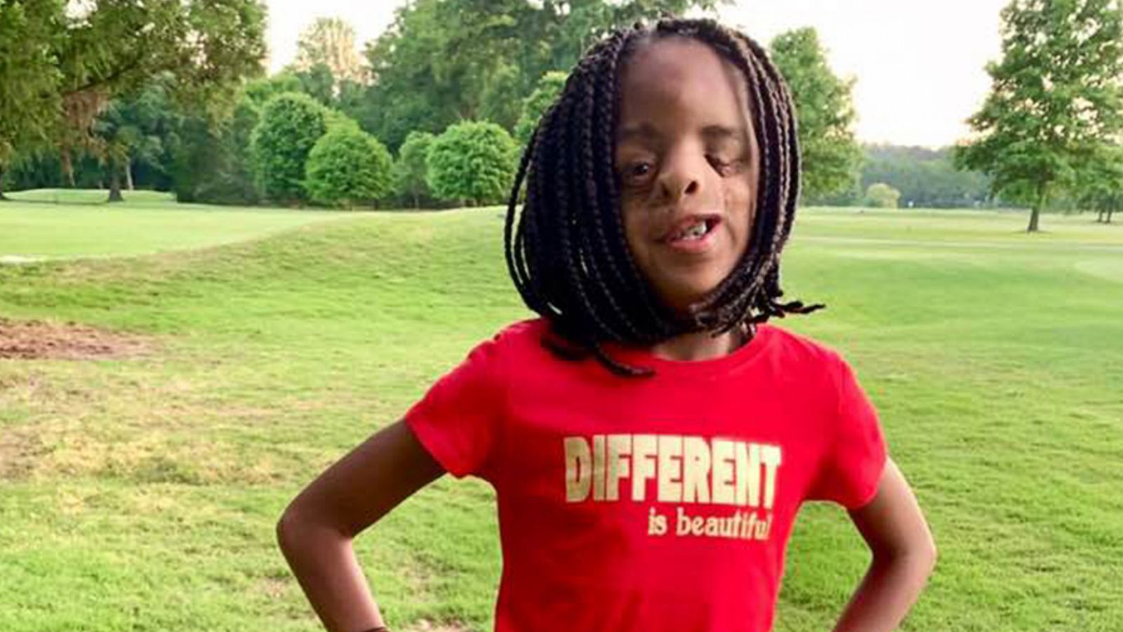 PHOTO: Destiny Strickland, 11, started the Different is Beautiful campaign to teach others that everyone is different in their own way.