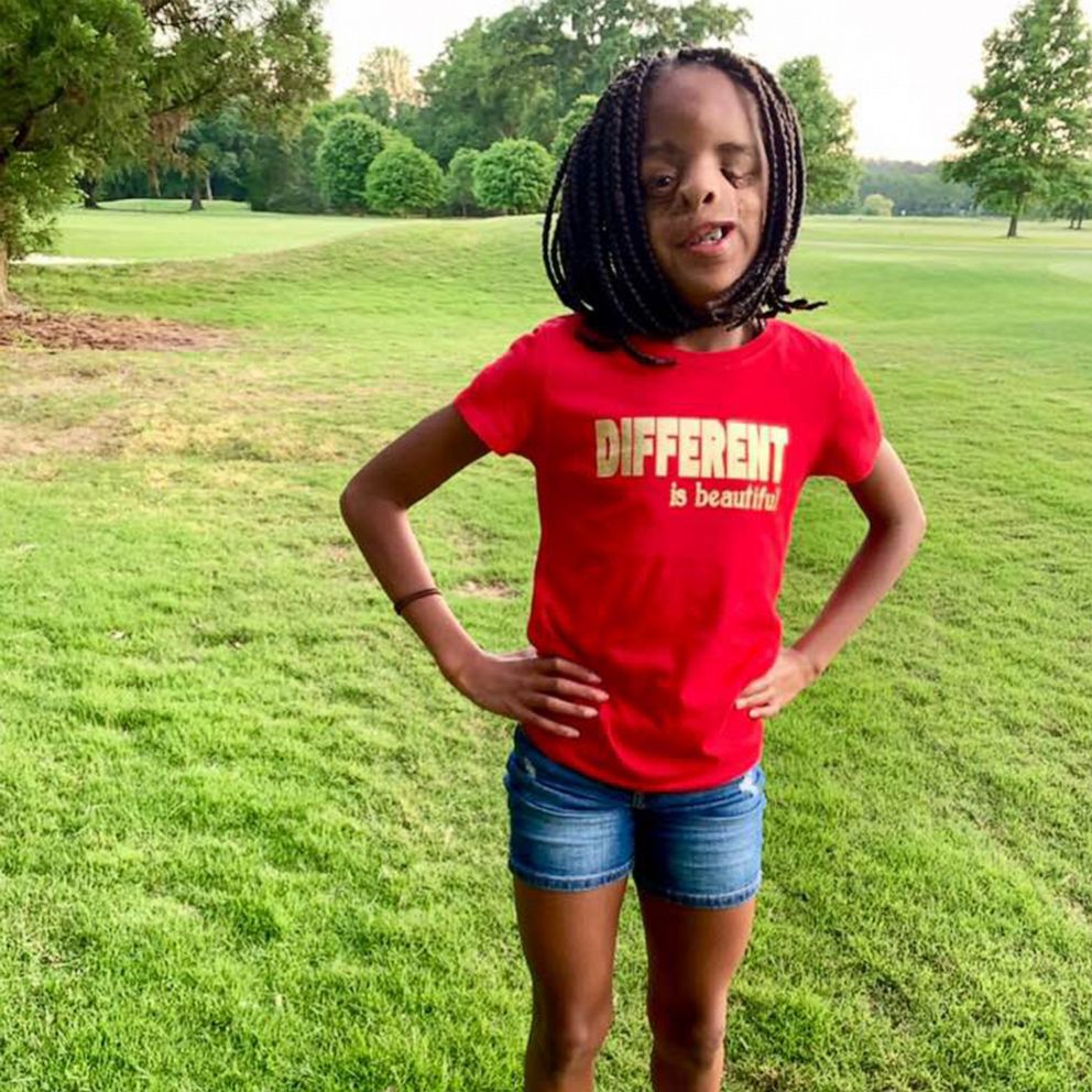 11-year-old girl teaches valuable lesson about embracing what makes you  different - Good Morning America