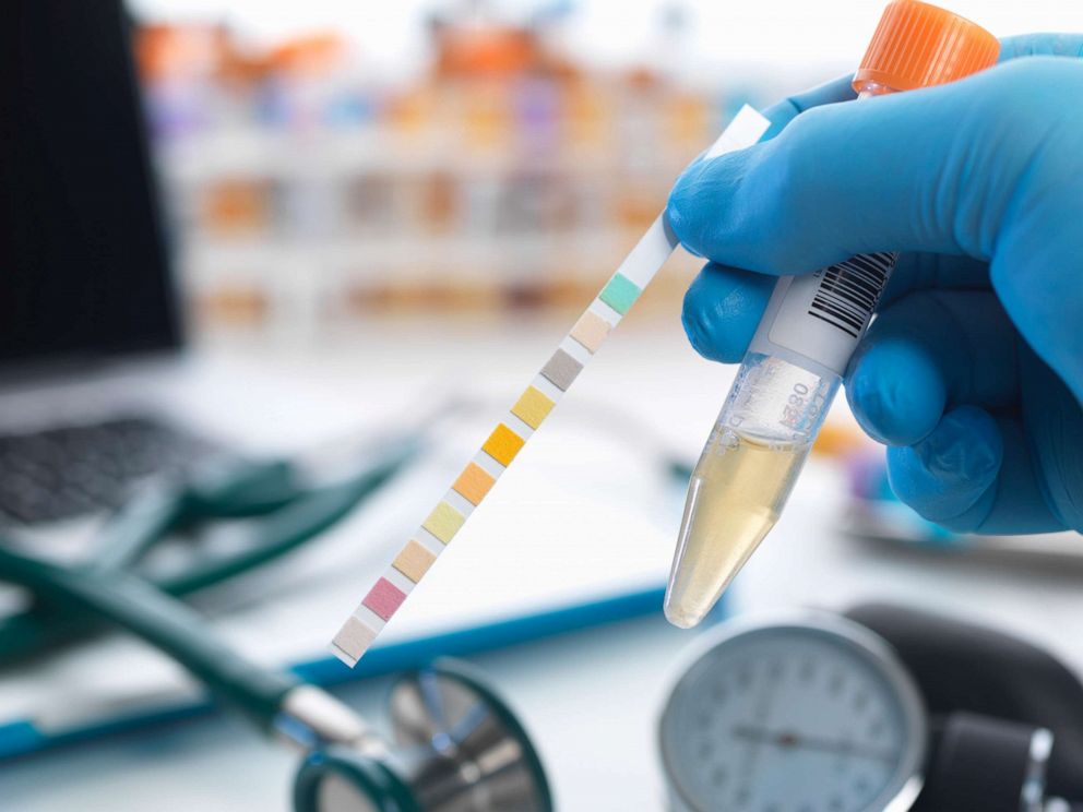 PHOTO: A urine test is posed in an undated stock photo. 