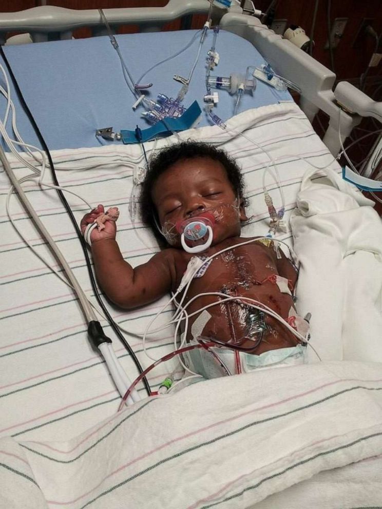 PHOTO: Morgan Price, of Alabama, underwent a heart transplant at four months old.
