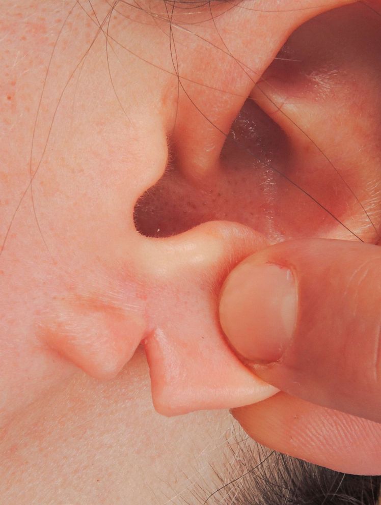 PHOTO: A split ear lobe is seen here.