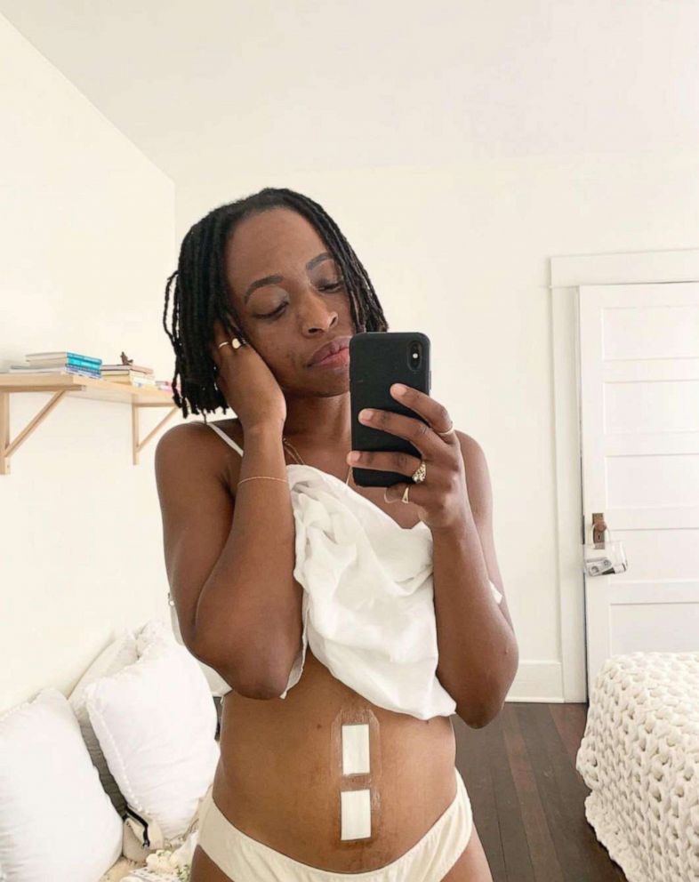 PHOTO: Erica Chidi is pictured while recovering from a 2019 procedure to remove uterine fibroids.
