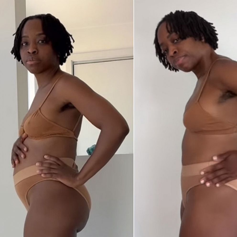 Woman has uterine fibroids removed that equaled the size of a 6
