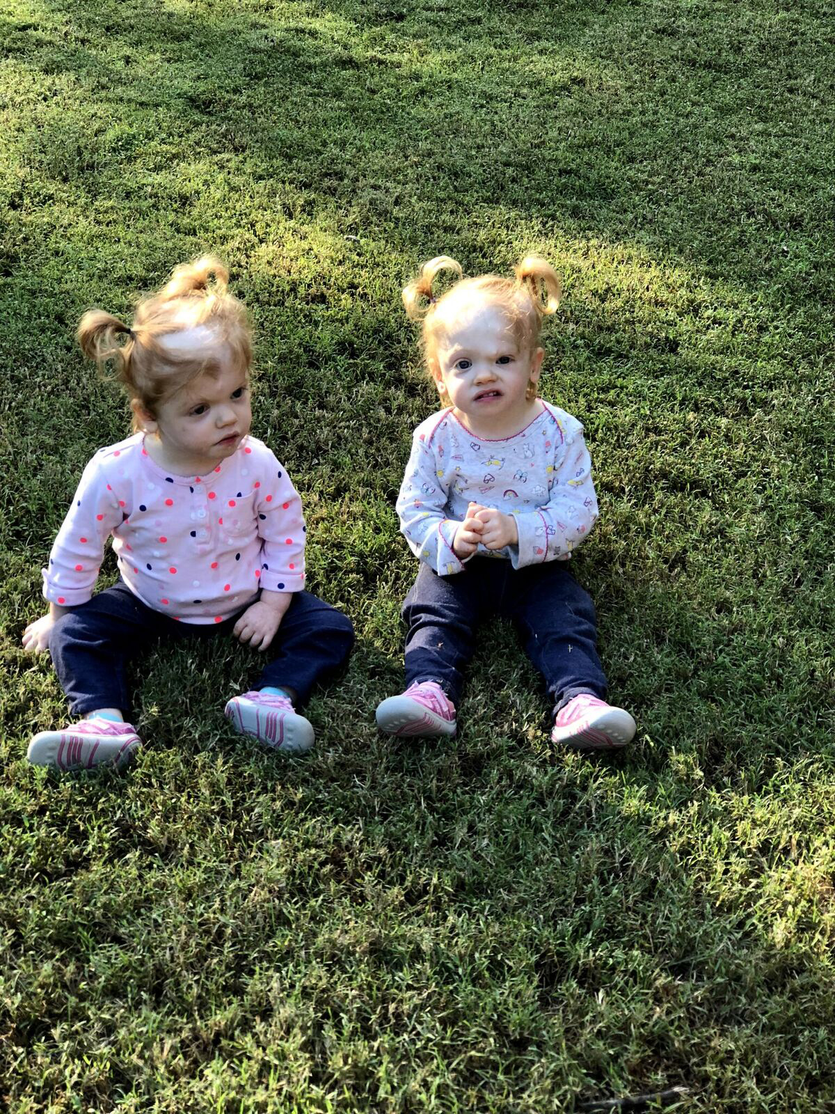 PHOTO: Erin and Abby Delaney are thriving two-year-olds, living with their parents Heather and Riley in Mooresville, N.C.