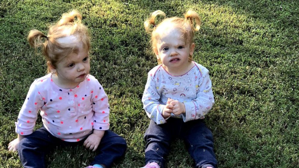 PHOTO: Erin and Abby Delaney are thriving two-year-olds, living with their parents Heather and Riley in Mooresville, N.C.