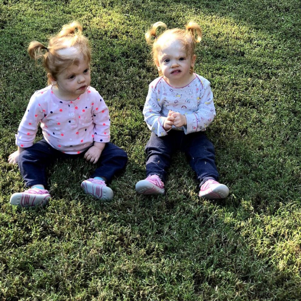 Twins who survived one of the rarest separation surgeries in the world