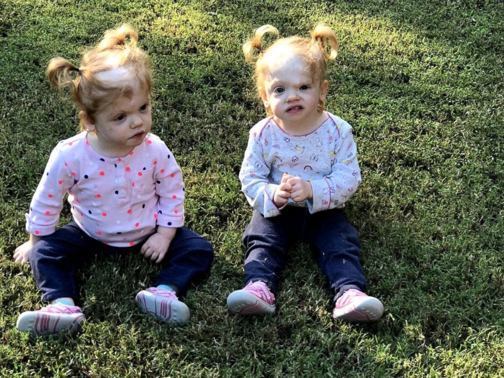 PHOTO: Erin and Abby Delaney are thriving two-year-olds, living with their parents Heather and Riley in Mooresville, N.C.