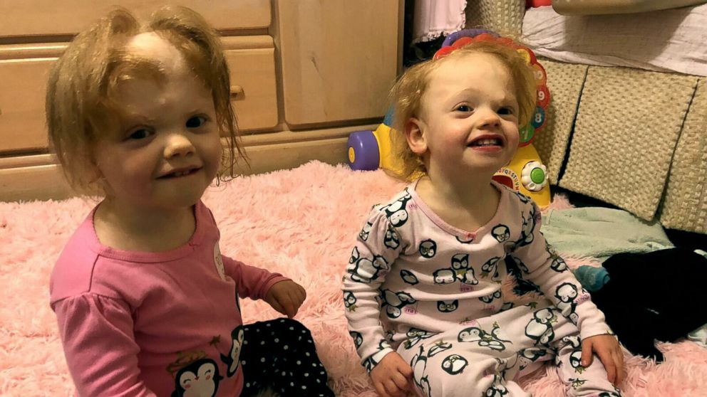 PHOTO: Twins Erin and Abby Delaney, now 2 years old, were born attached at the head but underwent one of the wrold's rarest separation surgeries. 