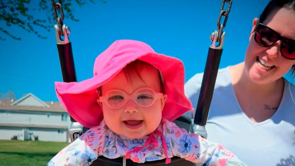 PHOTO: Madison Artalee, who was born with congenital cataracts, had to undergo three eye surgeries to save her vision.