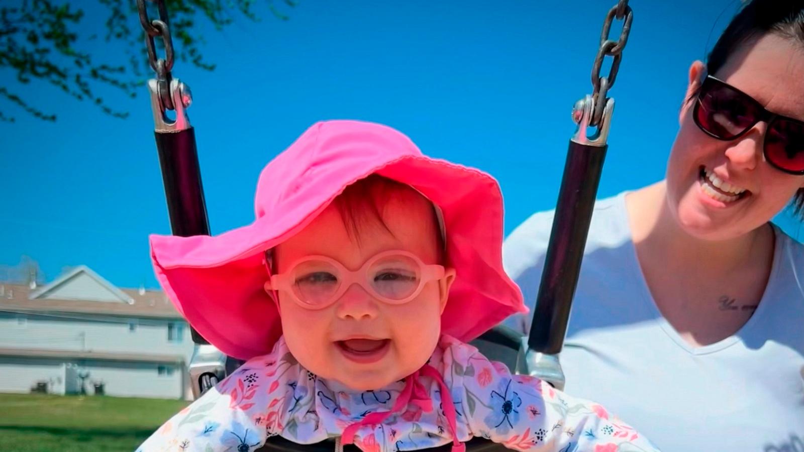 PHOTO: Madison Artalee, who was born with congenital cataracts, had to undergo three eye surgeries to save her vision.