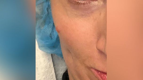 一名妇女在两年后被诊断为癌性肿瘤的脸上出现了一个标记后分享了警告
