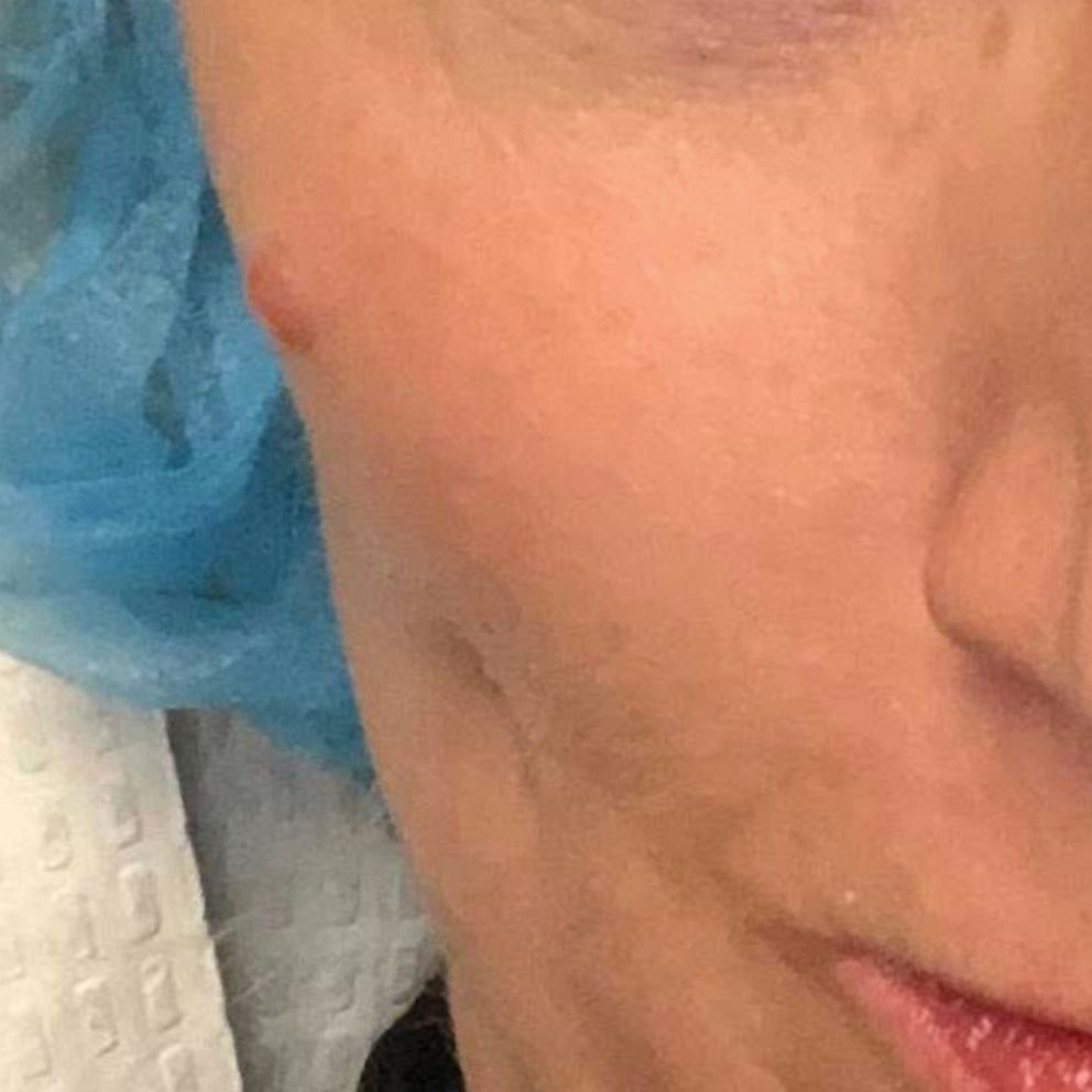 Woman Shares Warning After Mark On Face Diagnosed As Cancerous Tumor 2 