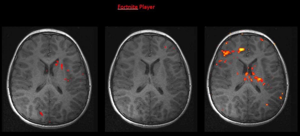 PHOTO: brain scans fortnite