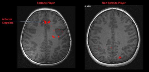 Does Fortnite Damage The Brain How Much Is Too Much Test Could Show The Effect Of Gaming On Your Kid S Brain Gma