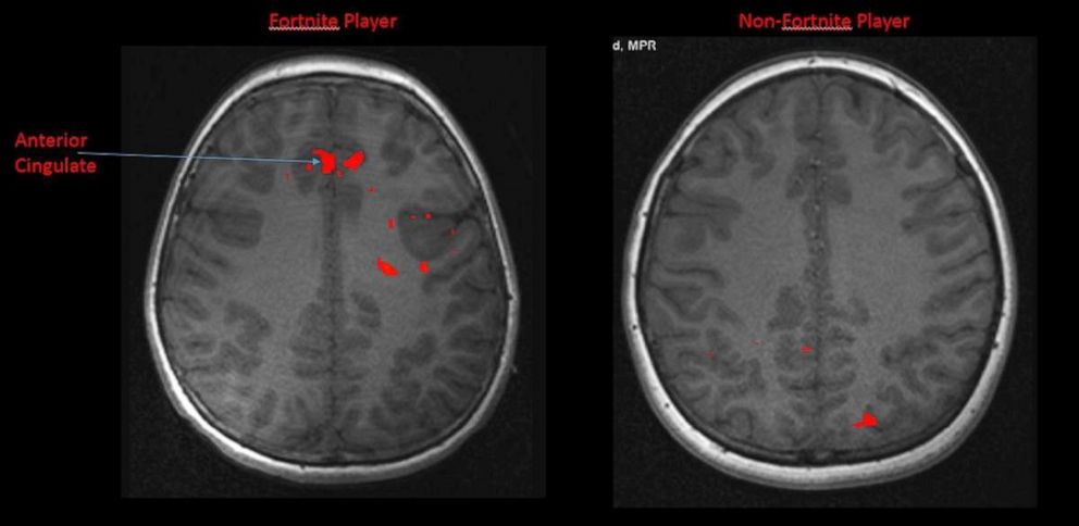 PHOTO: fortnite brain scans