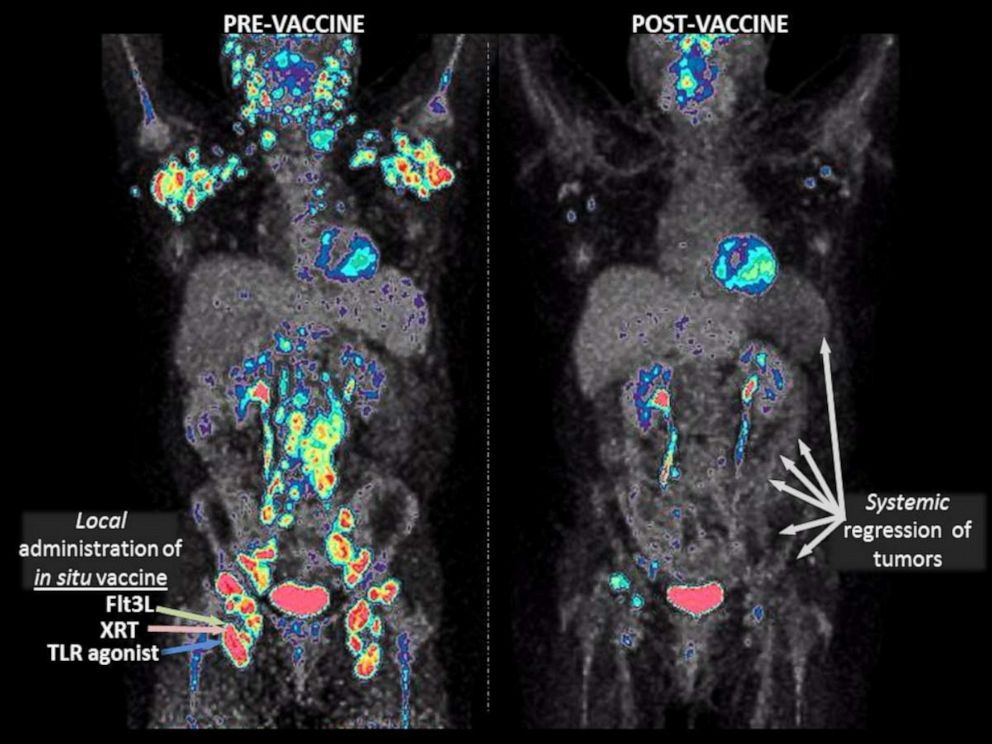 PHOTO: Radiographic imaging non-hodgkin's lymphoma vaccine