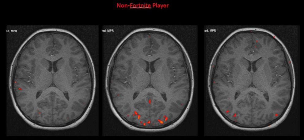 PHOTO: brain scan fortnite