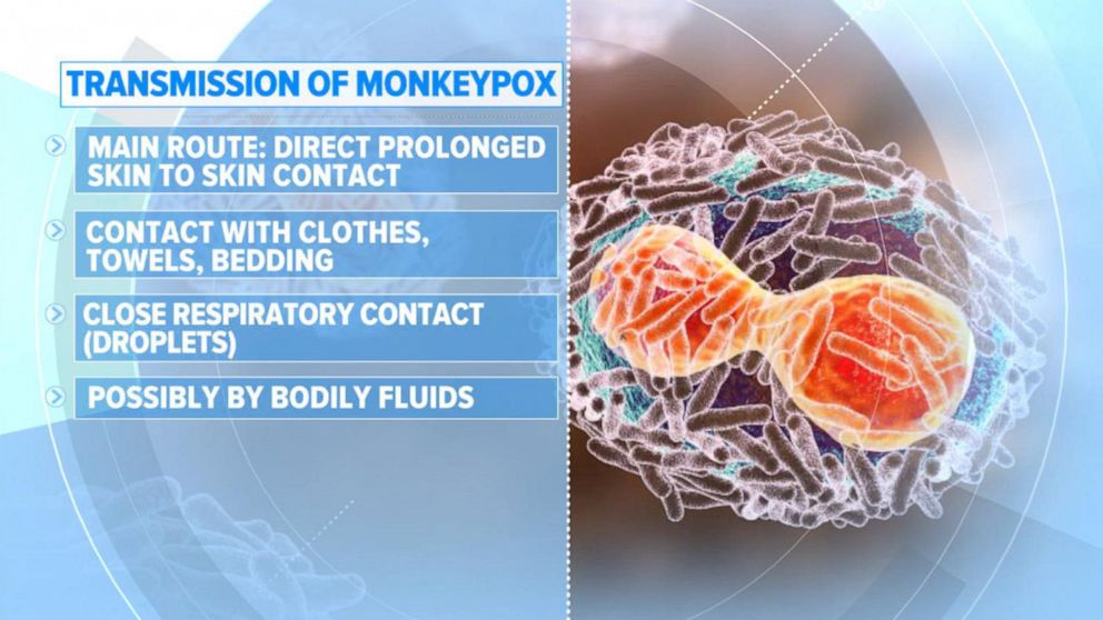 PHOTO: What to know about monkeypox as the virus continues to spread in the United States.