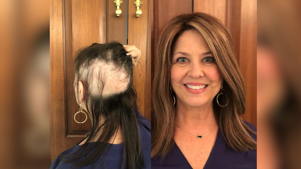 Hair loss doesn't just affect men. These women turn to 'toppers' to find  their confidence again. - Good Morning America