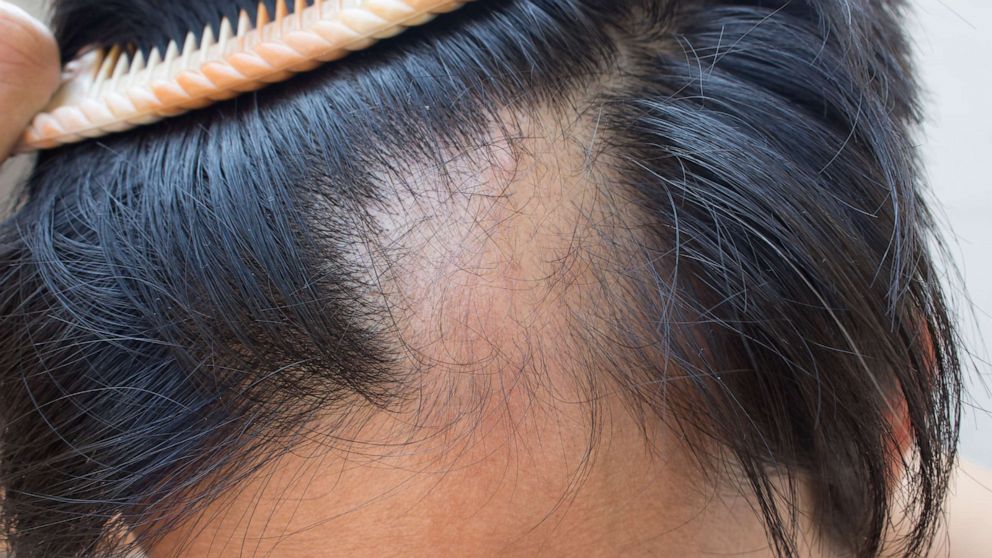 The FDA approves the first treatment that can regrow hair for teenagers with severe alopecia areata