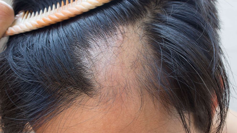 First alopecia treatment for autoimmune disorder that causes sudden hair  loss approved by the FDA