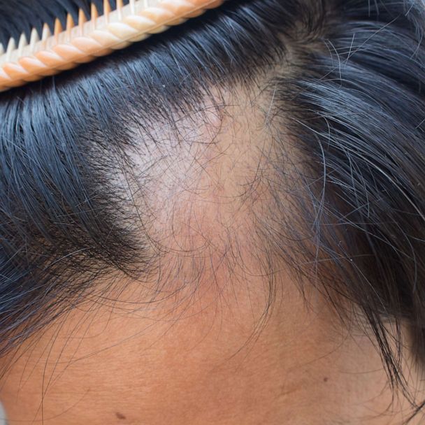 FDA approving medicine to treat patients suffering with severe Alopecia