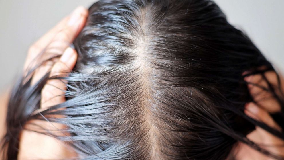 Hair loss: Causes include a high-fat diet | Express.co.uk
