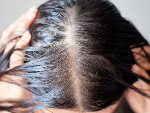 12 signs of hair loss to bring up to your dermatologist - Good Morning  America